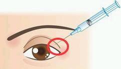 Non Cross Linked Medical Ophthalmic Sodium Hyaluronate Gel hyaluronic acid filler For Intr