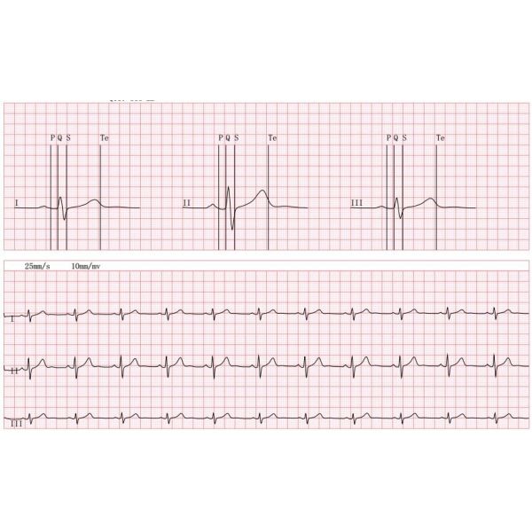 Telemetry Bluetooth EKG Check Recorder ECG Loop Recorder Android/IOS System