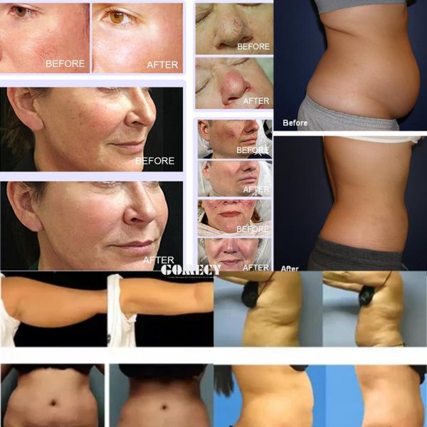 980nm 1470nm Липосакционная машина Удаление жира Лазерное оборудование липолиза