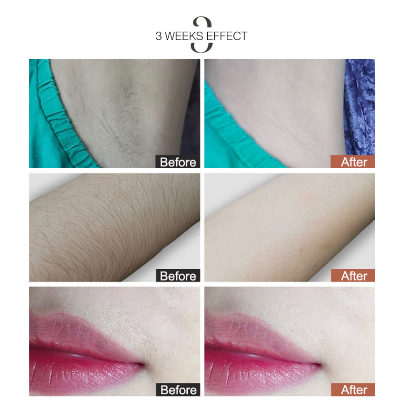 NO App-Controlled Household Laser Epilator The Must-Have for Women to Prevent Sunburn