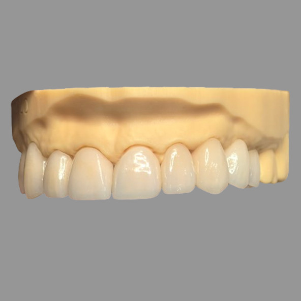 Smooth Pressed IPS EMax Crowns Staining Resistant Customizable