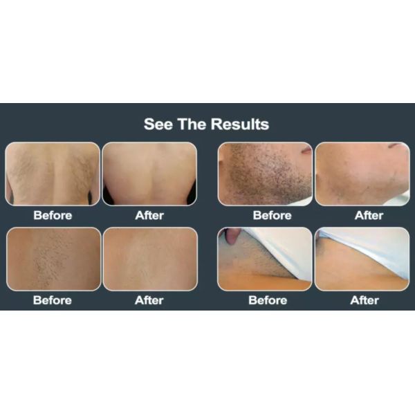 10Hz 2000W Diode 808 Laser Hair Removal Equipment