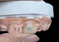 Les facettes EMAX transforment votre sourire avec des dents naturelles très translucides
