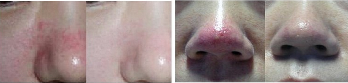 Portable Medical Spider Vein Diode Laser Vascular Removal Machine 980nm Professional