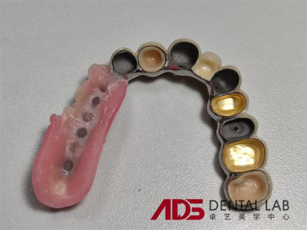 ADS Precision Attachment Dental Telescopic Crowns Mechanism