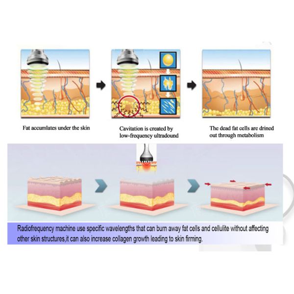 Home Fat Reduction Equipment  Supprted By Patent Anti  -  Cold Damage Technology