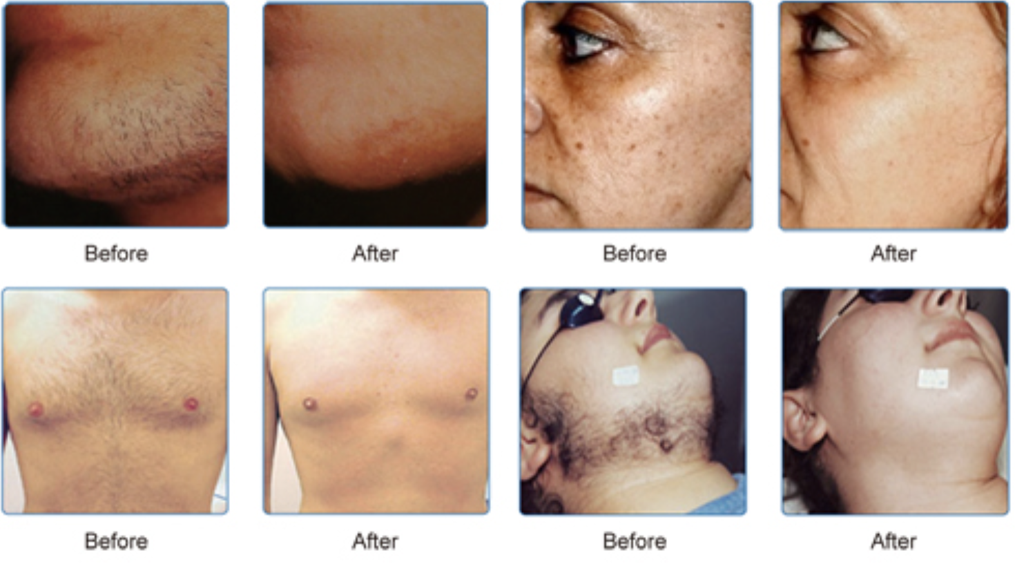 560 Nm 640 Nm Ipl Laser Hair Removal Permanent Machine Anti Wrinkle