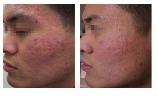 5mhz Touch High Quality Screen Thermage Skin Treatment Machine Nubway