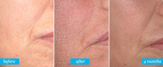 Carbon Dioxide CO2 Fractional Laser Machine For Skin Scar Treatment