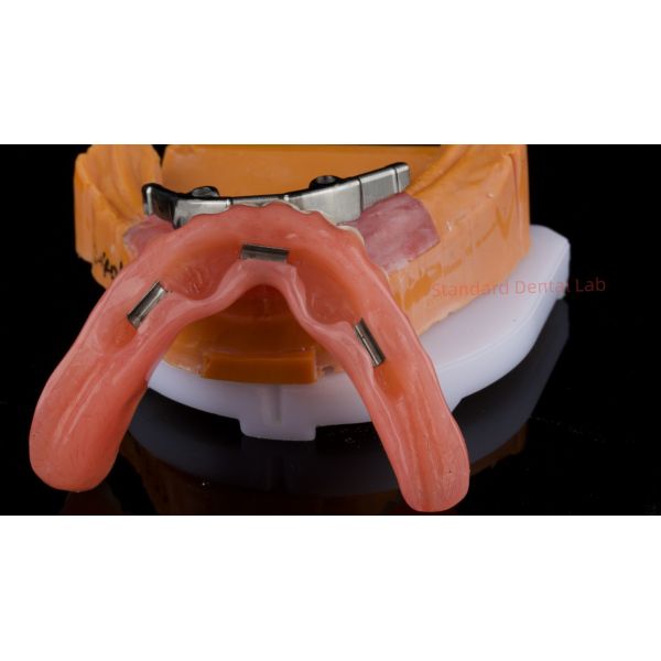 Ivoclar Digital Dental Implant Bar Denture with Attachments Full Acrylic Denture Titanium Implant Supported Dentures