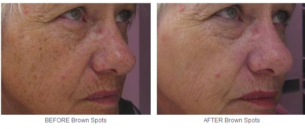 Powerful And Stable IPL SHR Hair Removal Machine 1 Million Shots For Women