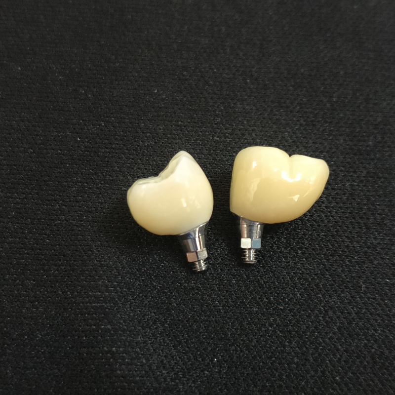 Chinese Dental Lab Teeth Implants 3D Laser Printing Customized