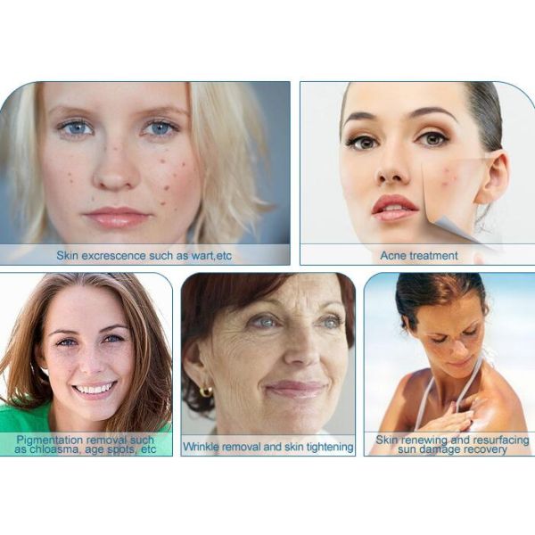 Newly professional skin rejuvenation co2 fractional laser with RF tube