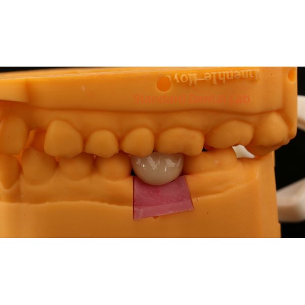 Screw Retained PFZ Porcelain Layered Zirconia Dental Implant Crown from Dental Lab ISO FDA CE Certified with 5-Year Guarantee