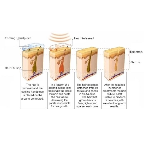 Wrinkle Remove E Light Laser Hair Removal Machine  Fast Shots AFT SHR  For Salon SPA