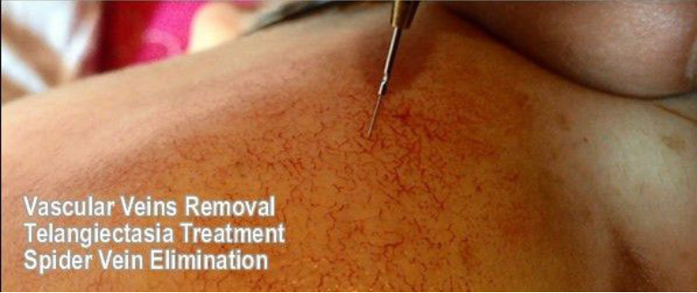Painless most effective spider vein, thread vein and skin tag removal device