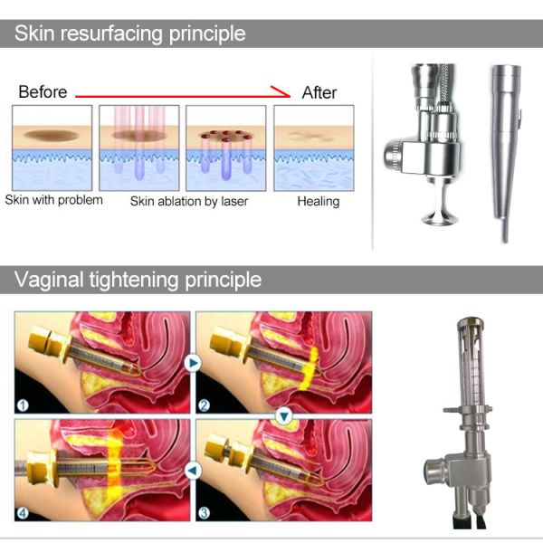 Машина лазера частичного СО2 RF 10600nm 10.6um влагалищная затягивая
