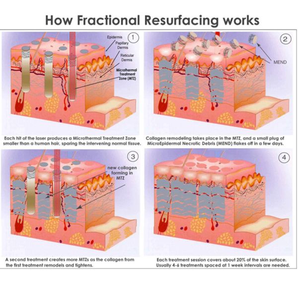 Medical Laser Skin Resurfacing Machine , Acne Scar Removal Fractional Co2 Laser Machine