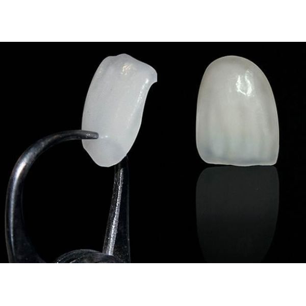 Emax Veneer