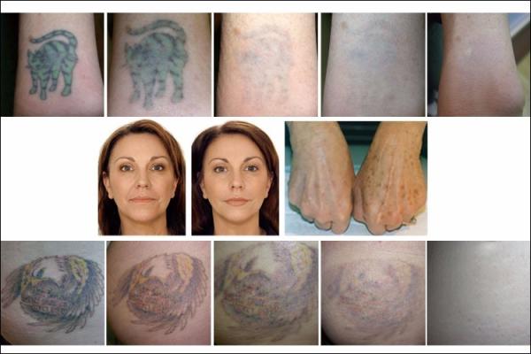 Cryotherapy Vacuum Picosecond Laser Tattoo Removal Machine ND YAG