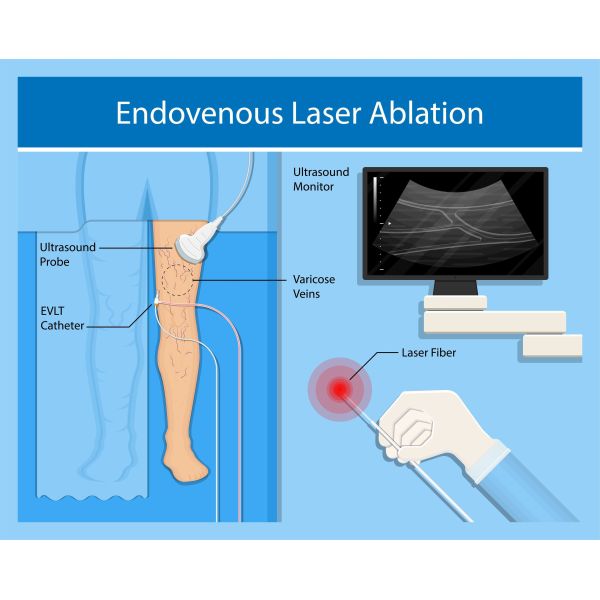 980+1470nm Laser Devices Mini Invasive Endovenous Laser Varicose Vein Surgery