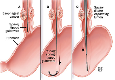 расширитель Bougie 800 mm устранимый для сердечной обработки стриктуры