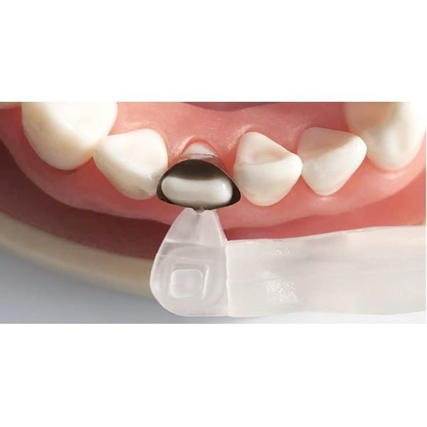 Universal Matrix Band Retainer M5 2.0