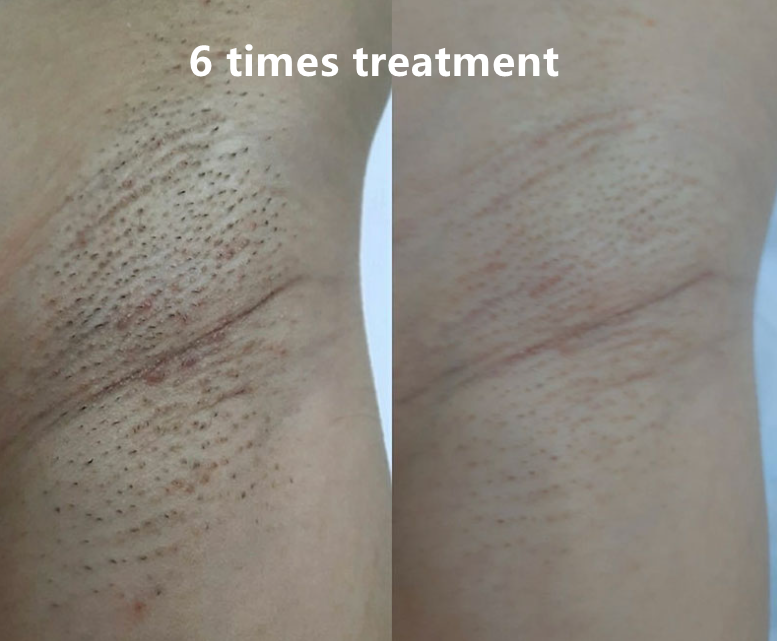 Диодная лазерная удаление волос 800 Вт 755 нм 1064 нм 808 нм трио лазерная машина