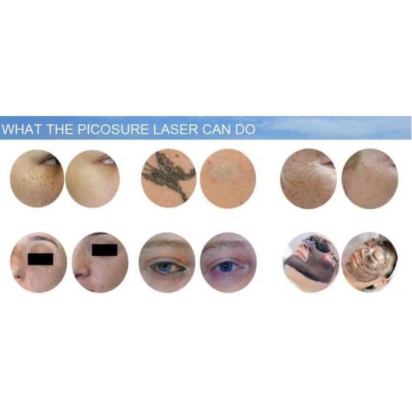 Picosure Q Switched Nd Yag Laser Machine For Freckles / Pigment / Age Spots Removal