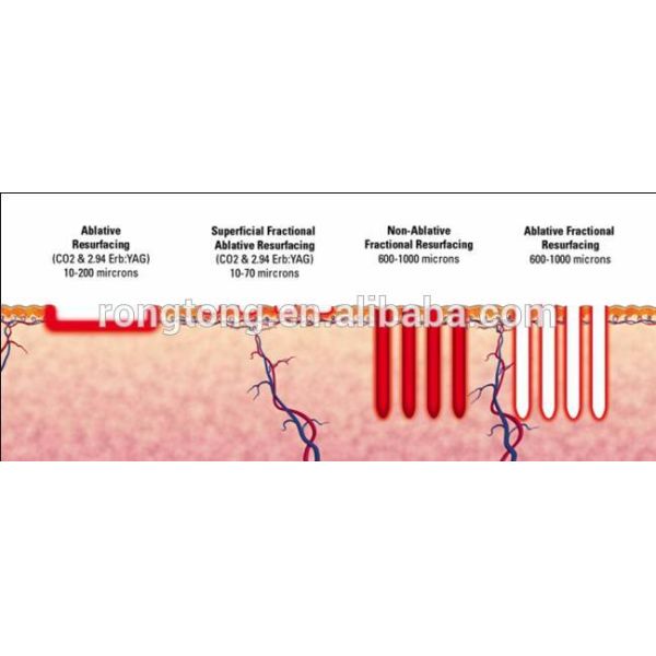 RF Tube Co2 Fractional Laser Technology Beauty Machine for Acne Scar Removal
