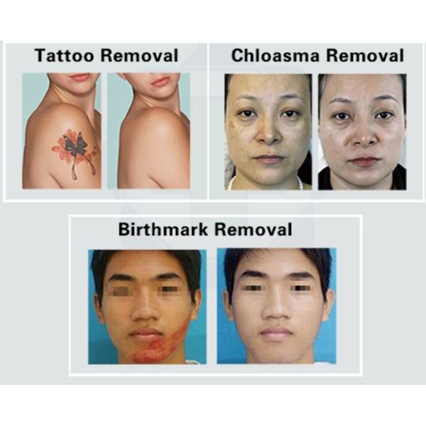 2 -10mm Adjustable Picosecond Laser Tattoo Removal Machine 755nm 1064nm 532nm Spot Size