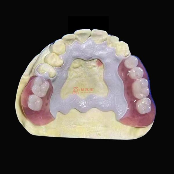 3D Printing Peek Frame Removable Dentures Acrylic Teeth China Dental Lab