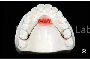 Adjustable Mouth Expanding Retainer For Safe Teeth Retention And Expansion