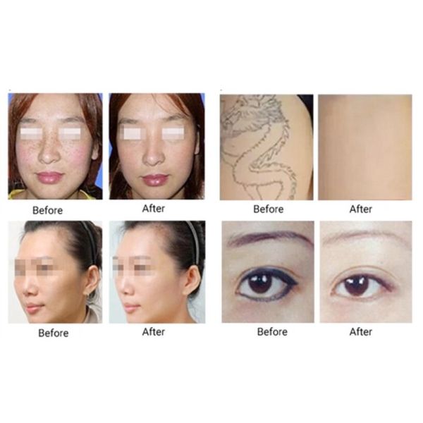 532 755 1064nm Q Switched Nd Yag Laser Machine , Picosecond Tattoo Removal Equipment