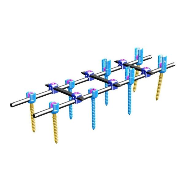 Orthopedics Spinal Internal Fixation Ⅳ Spinal Fixation System