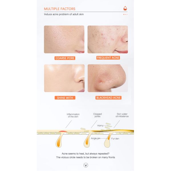 Тонер для кожи маслообразного угорь прональной разводя лицевой туман водой стороны салициловой кислоты BHA тонера AHA