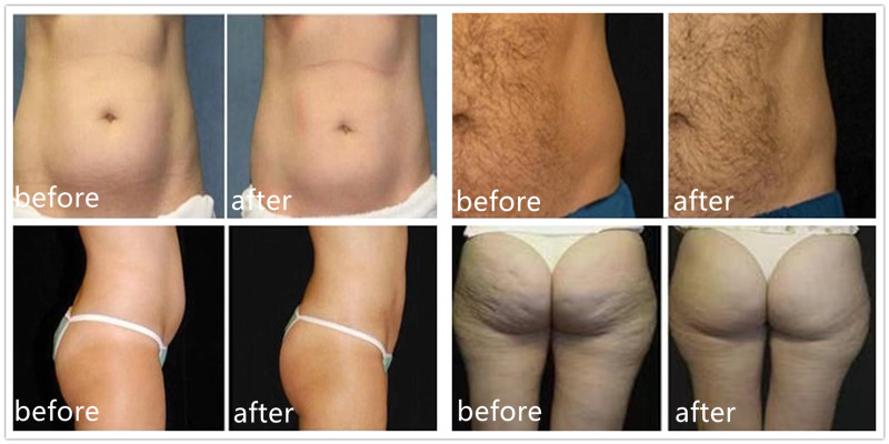Машина 110V 60Hz Cryolipolysis дома экрана касания или высокая эффективность 220v 50Hz