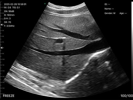 USB Convex Ultrasound Transducer Wireless Convex Array Ultrasound Probe for OB/GYN Lung Urology Application
