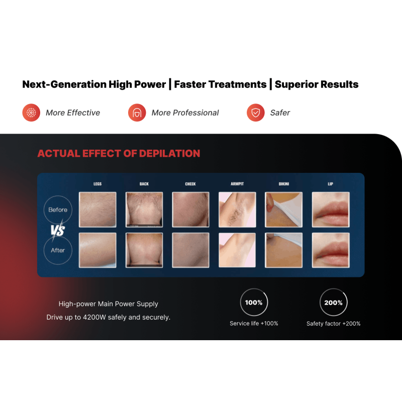 Diode laser hair removal