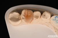 Zirconia Inlay Onlay With Adhesive Cementation For Damaged Teeth Restoration