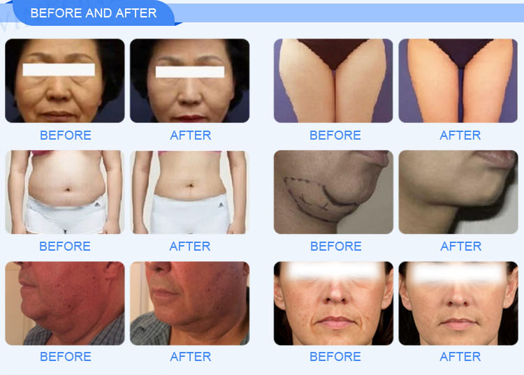 Машина против старения новой кожи стороны машины красоты rejuvenating трехмерная