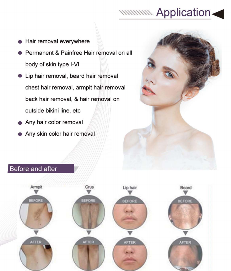 La mejor máquina del retiro del pelo del laser del diodo de la longitud de onda de la venta 755nm 808nm 1064nm tres