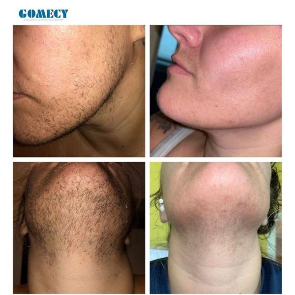 Electrolysis System Permanent Solution Removing  Hair Colors and Vascular Removal Machine