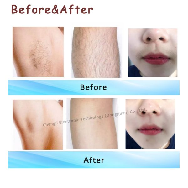 Máquina de depilación por láser de velocidad de hielo Máquina de depilación por láser permanente 808