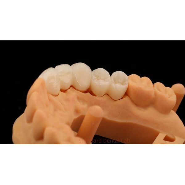 High Aesthetic Anterior Teeth Full Contour Zirconia Crown with Customized Vita Shade Dental Lab