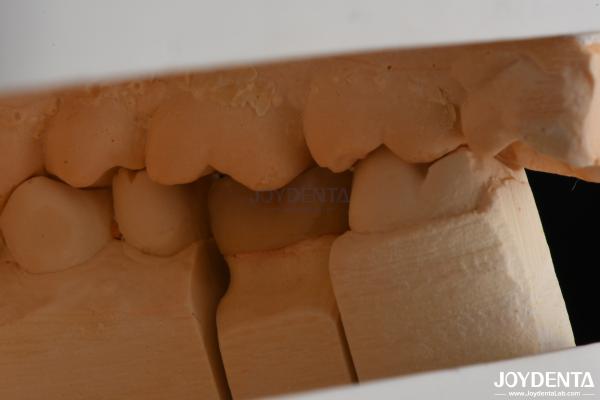 Custom Compound Inlay Onlay For Minimally Invasive Dental Restoration