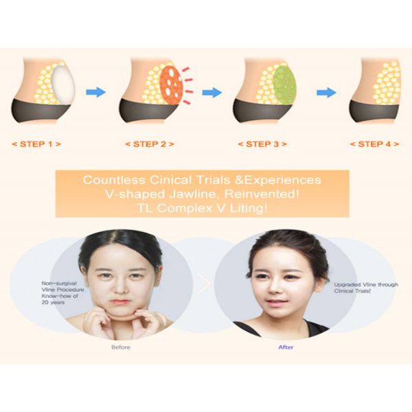 Уменьшение весу Aqualyxs Kabellines Kybellas Lipolab V Line Ppc Solution