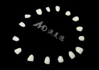 Carillas de porcelana IPS EMAX para restauraciones de dientes frontales de aspecto natural