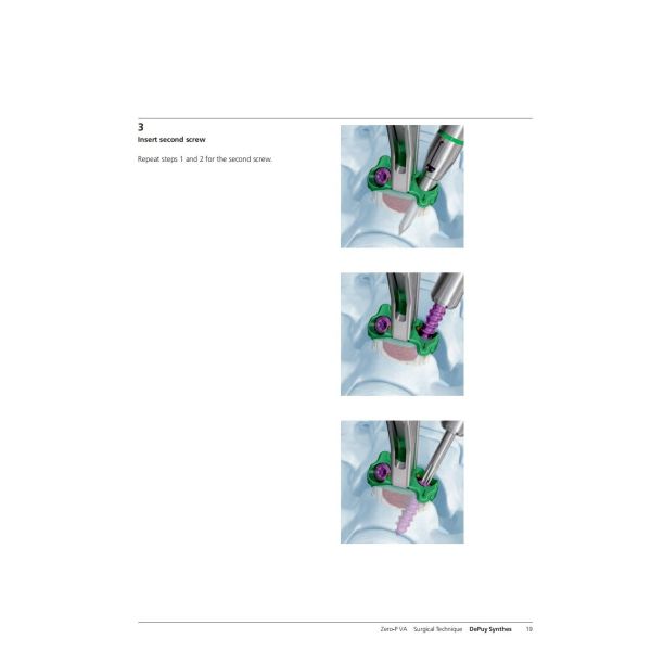 Sterilization 2 Screws Zero Profile Cage Anterior Cervical Cage Stand Alone CE Spinal Surgery
