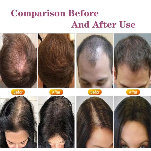 Новые зубы металла конструируют гребень Regrowth волос массажа вибрации лазера Ems обработки выпадения волос электрический с жидкостным проводником